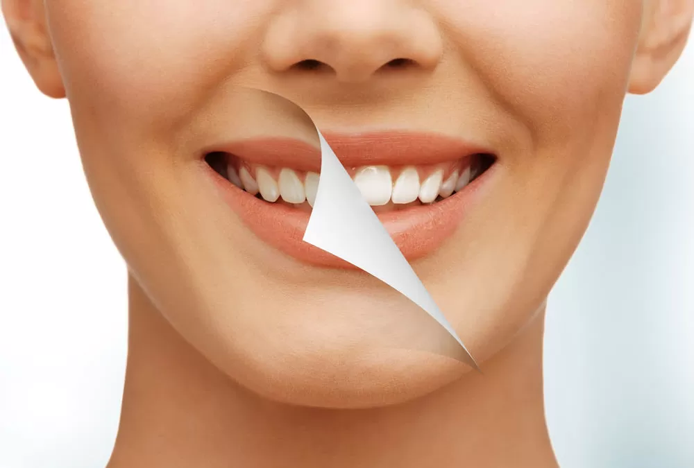 Como é feito o clareamento dental e o que comer após o procedimento