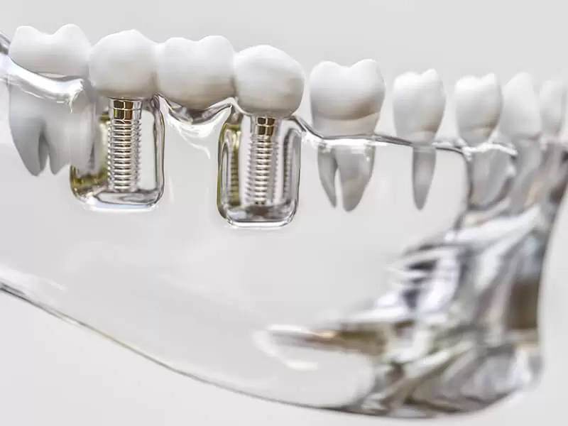 Saiba quanto tempo dura um implante dentário